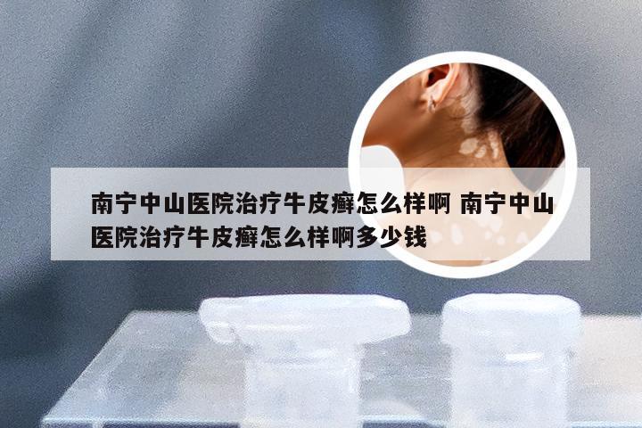 南宁中山医院治疗牛皮癣怎么样啊 南宁中山医院治疗牛皮癣怎么样啊多少钱