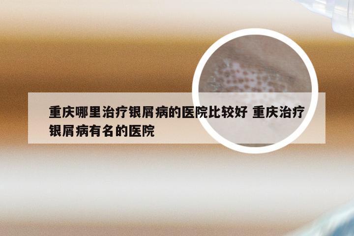 重庆哪里治疗银屑病的医院比较好 重庆治疗银屑病有名的医院