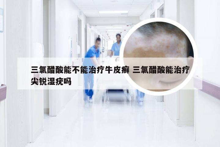 三氯醋酸能不能治疗牛皮癣 三氯醋酸能治疗尖锐湿疣吗