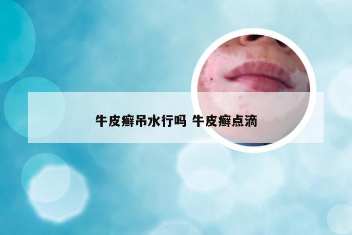 牛皮癣吊水行吗 牛皮癣点滴