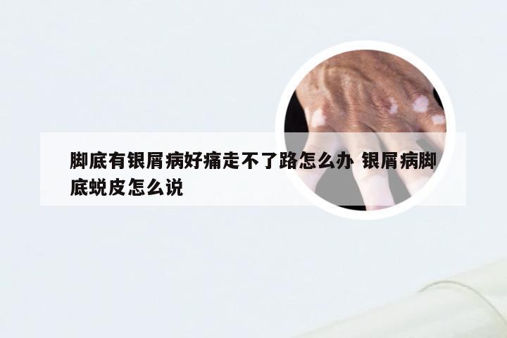 脚底有银屑病好痛走不了路怎么办 银屑病脚底蜕皮怎么说