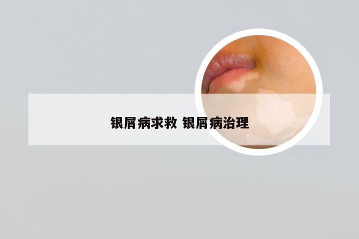 银屑病求救 银屑病治理