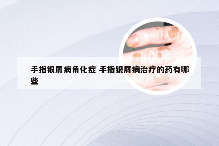 手指银屑病角化症 手指银屑病治疗的药有哪些