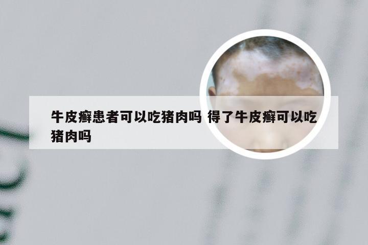 牛皮癣患者可以吃猪肉吗 得了牛皮癣可以吃猪肉吗