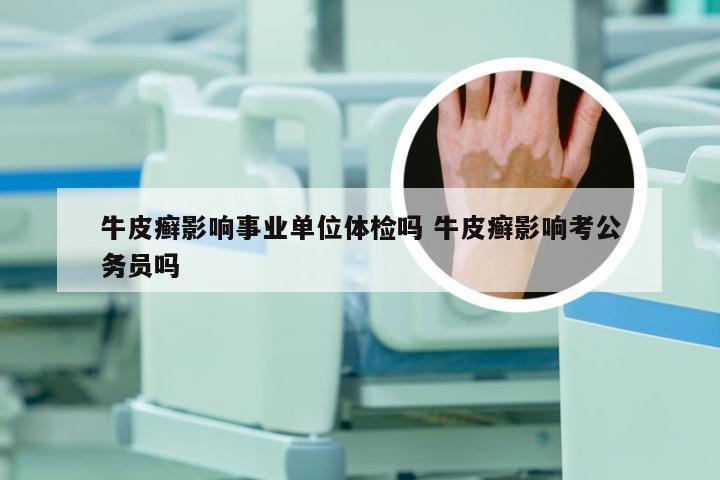 牛皮癣影响事业单位体检吗 牛皮癣影响考公务员吗