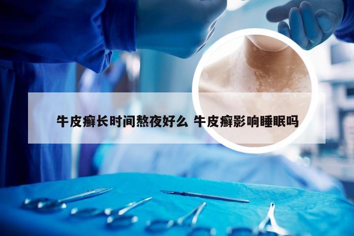 牛皮癣长时间熬夜好么 牛皮癣影响睡眠吗