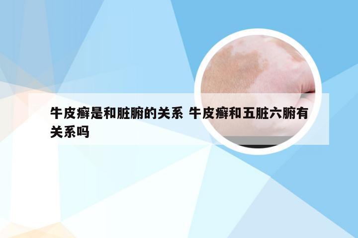 牛皮癣是和脏腑的关系 牛皮癣和五脏六腑有关系吗