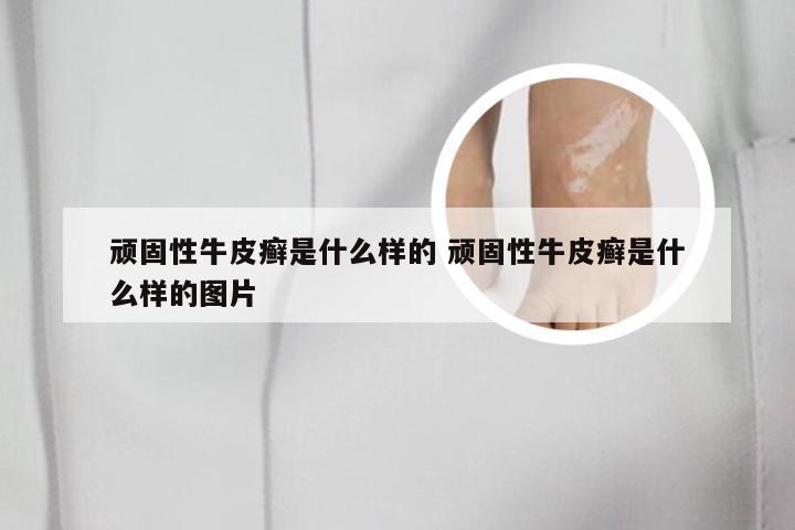顽固性牛皮癣是什么样的 顽固性牛皮癣是什么样的图片