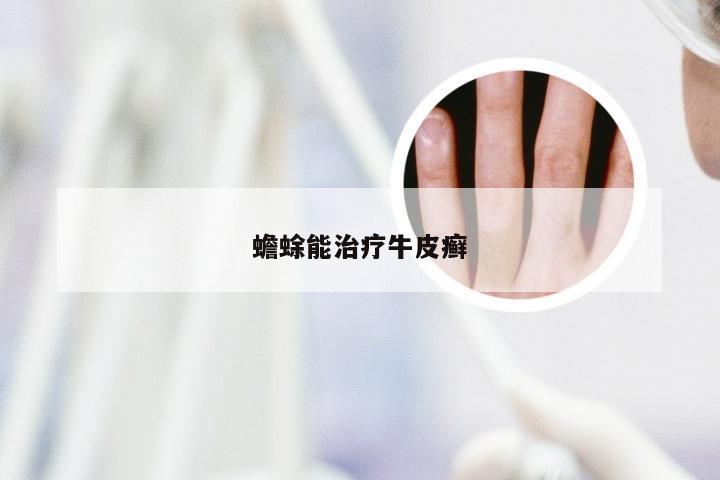 蟾蜍能治疗牛皮癣