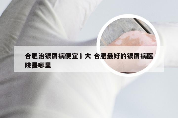 合肥治银屑病便宜軍大 合肥最好的银屑病医院是哪里