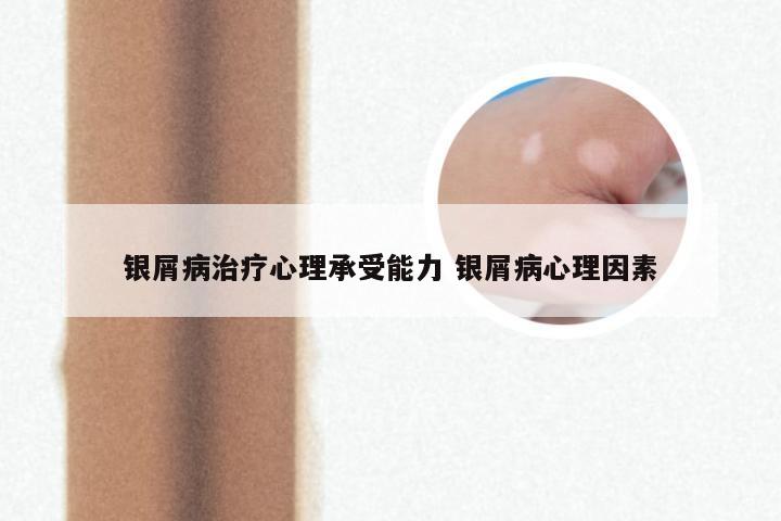 银屑病治疗心理承受能力 银屑病心理因素