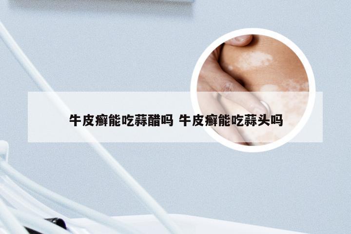 牛皮癣能吃蒜醋吗 牛皮癣能吃蒜头吗