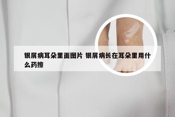 银屑病耳朵里面图片 银屑病长在耳朵里用什么药擦