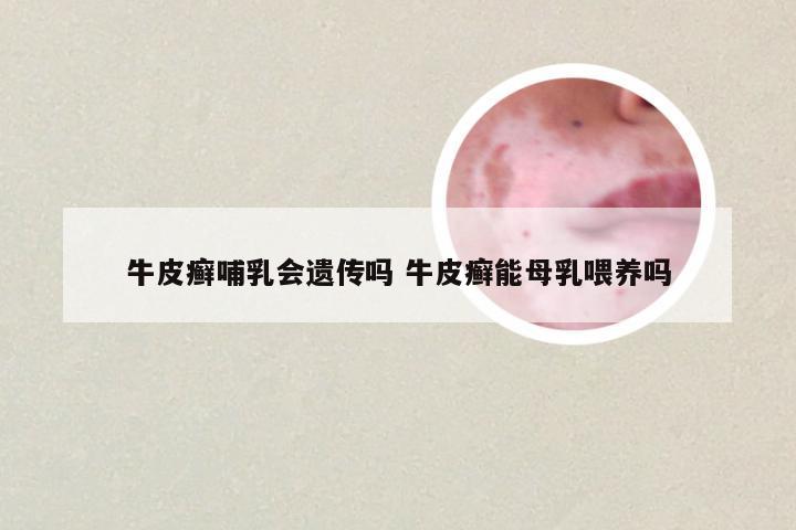 牛皮癣哺乳会遗传吗 牛皮癣能母乳喂养吗