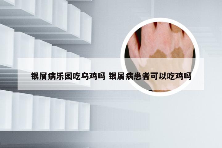 银屑病乐园吃乌鸡吗 银屑病患者可以吃鸡吗
