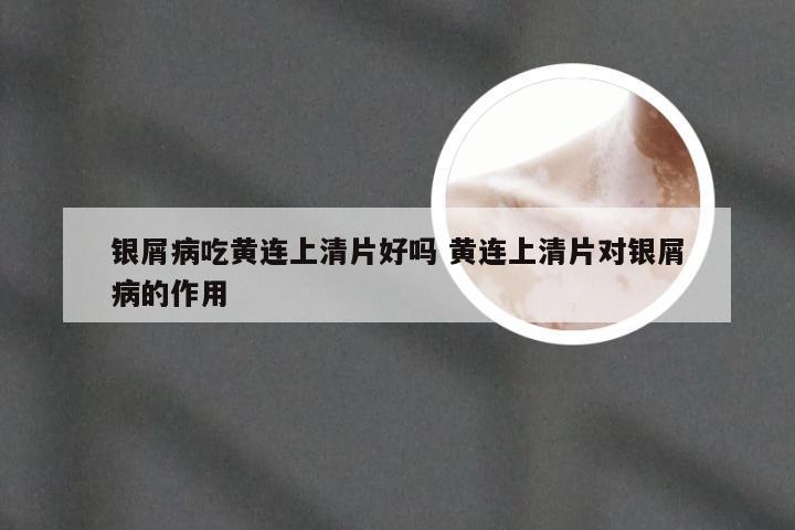 银屑病吃黄连上清片好吗 黄连上清片对银屑病的作用