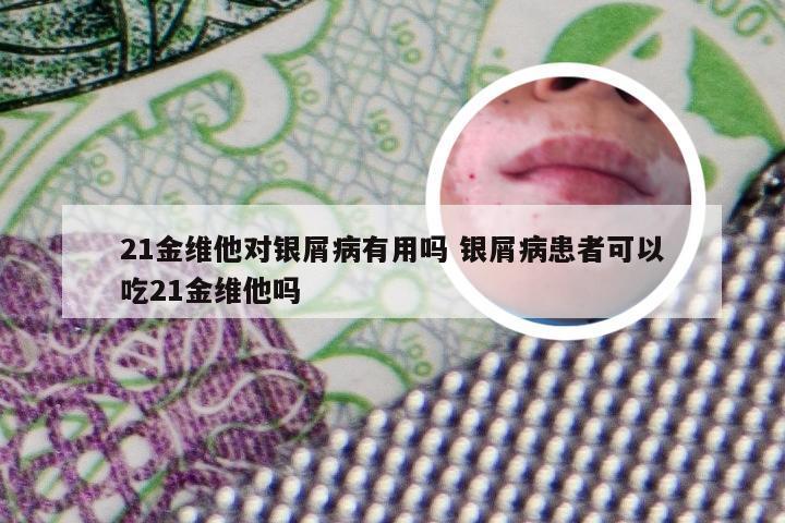 21金维他对银屑病有用吗 银屑病患者可以吃21金维他吗