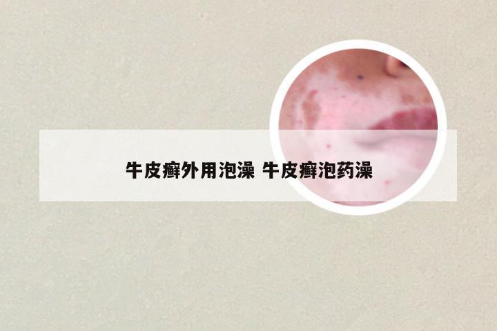 牛皮癣外用泡澡 牛皮癣泡药澡