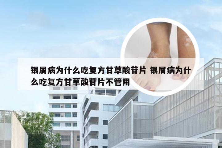 银屑病为什么吃复方甘草酸苷片 银屑病为什么吃复方甘草酸苷片不管用