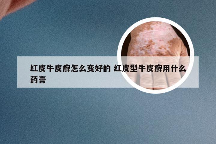 红皮牛皮癣怎么变好的 红皮型牛皮癣用什么药膏