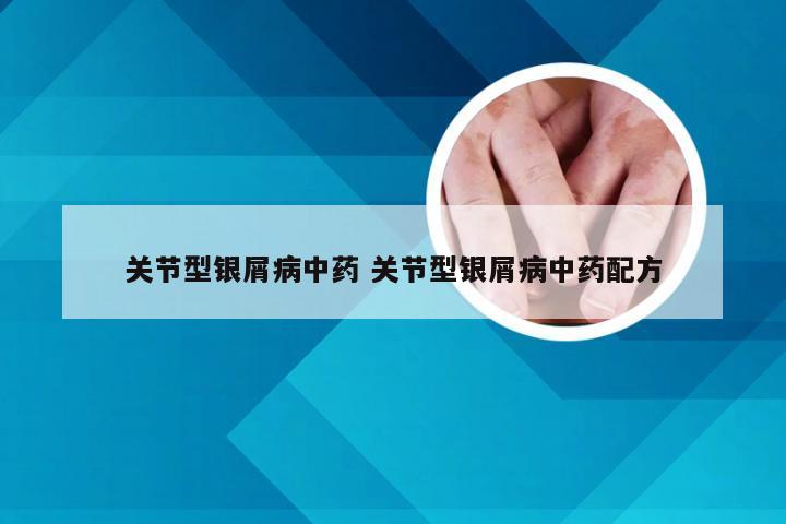关节型银屑病中药 关节型银屑病中药配方