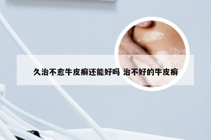 久治不愈牛皮癣还能好吗 治不好的牛皮癣
