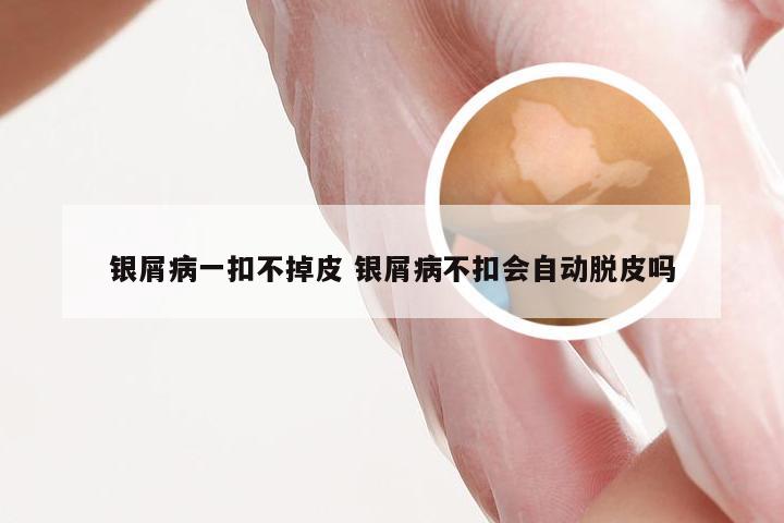 银屑病一扣不掉皮 银屑病不扣会自动脱皮吗