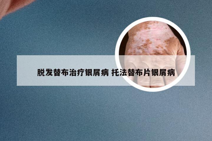 脱发替布治疗银屑病 托法替布片银屑病
