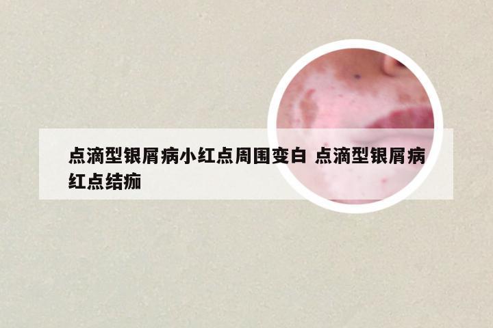 点滴型银屑病小红点周围变白 点滴型银屑病红点结痂