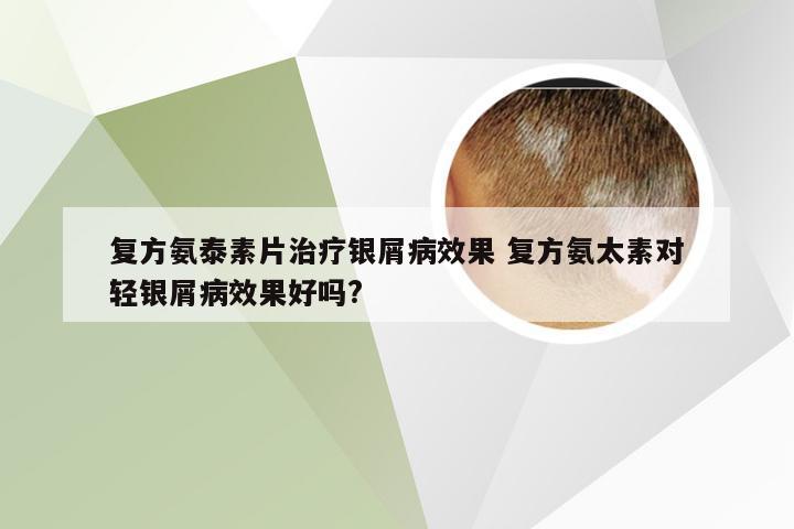复方氨泰素片治疗银屑病效果 复方氨太素对轻银屑病效果好吗?