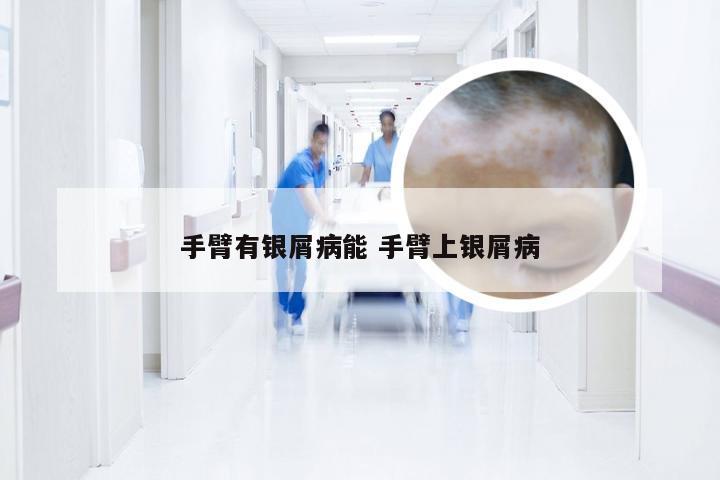 手臂有银屑病能 手臂上银屑病