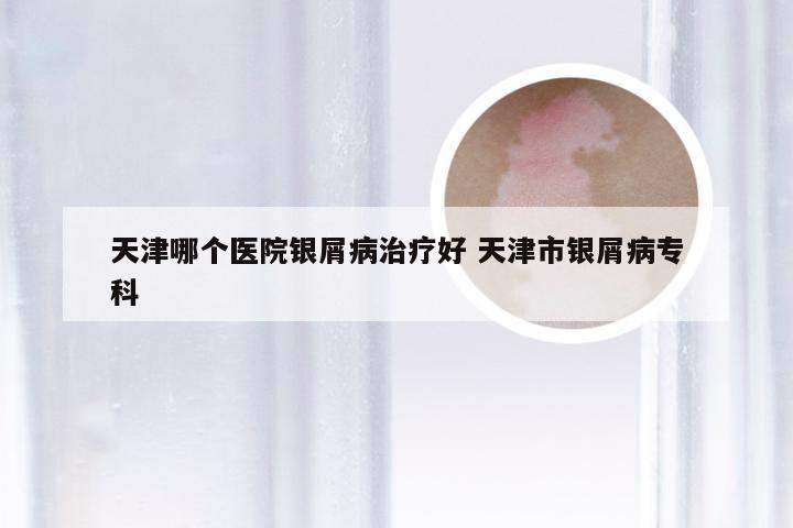 天津哪个医院银屑病治疗好 天津市银屑病专科