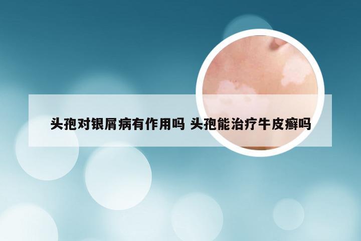 头孢对银屑病有作用吗 头孢能治疗牛皮癣吗