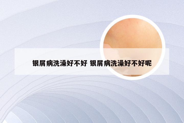 银屑病洗澡好不好 银屑病洗澡好不好呢