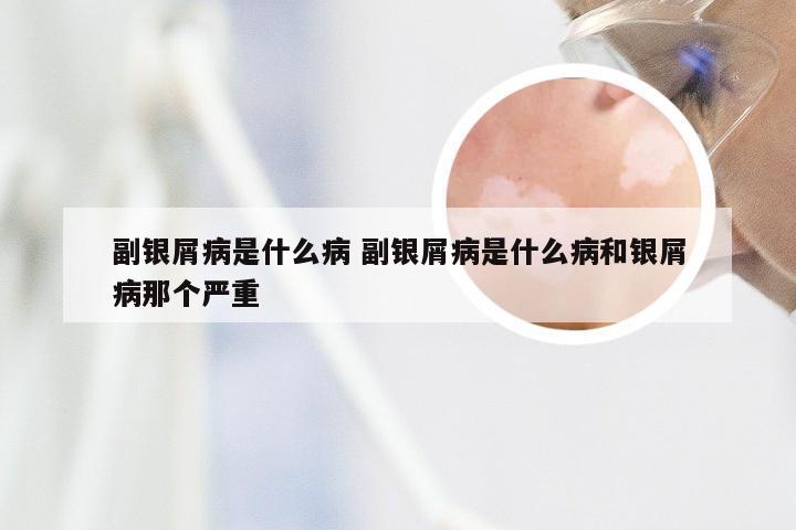 副银屑病是什么病 副银屑病是什么病和银屑病那个严重