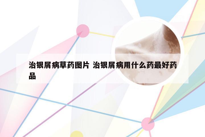 治银屑病草药图片 治银屑病用什么药最好药品
