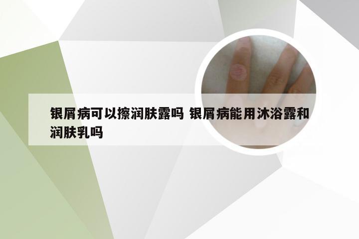 银屑病可以擦润肤露吗 银屑病能用沐浴露和润肤乳吗