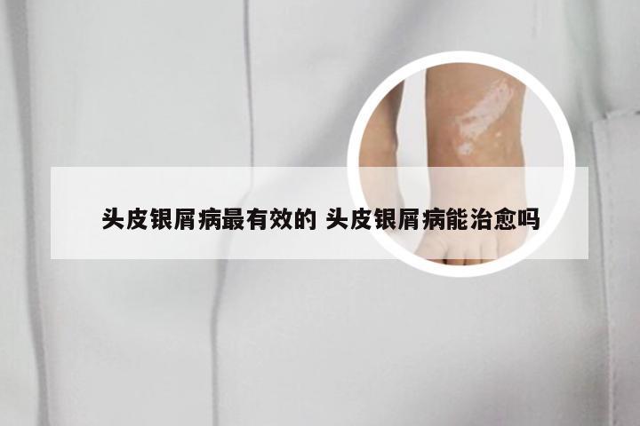 头皮银屑病最有效的 头皮银屑病能治愈吗