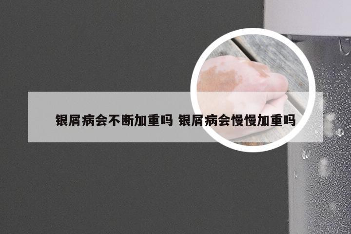 银屑病会不断加重吗 银屑病会慢慢加重吗