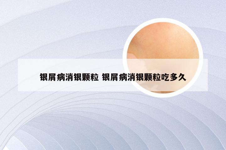 银屑病消银颗粒 银屑病消银颗粒吃多久