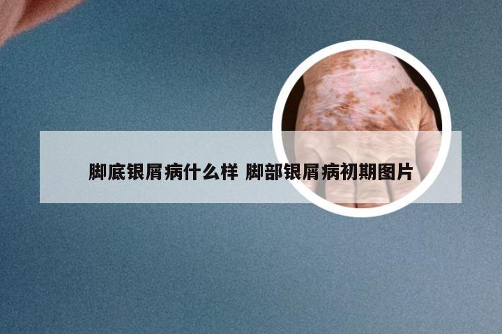 脚底银屑病什么样 脚部银屑病初期图片