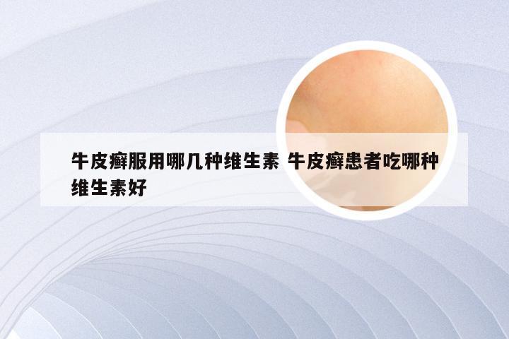 牛皮癣服用哪几种维生素 牛皮癣患者吃哪种维生素好