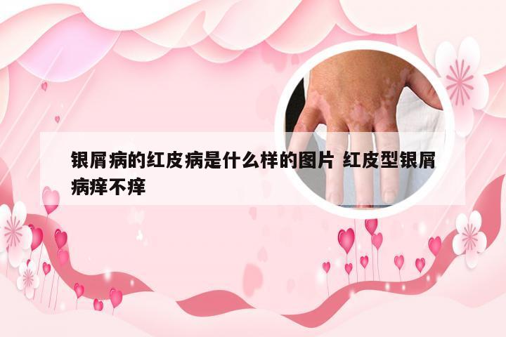 银屑病的红皮病是什么样的图片 红皮型银屑病痒不痒