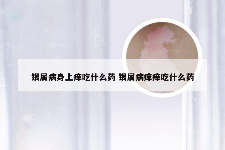 银屑病身上痒吃什么药 银屑病痒痒吃什么药