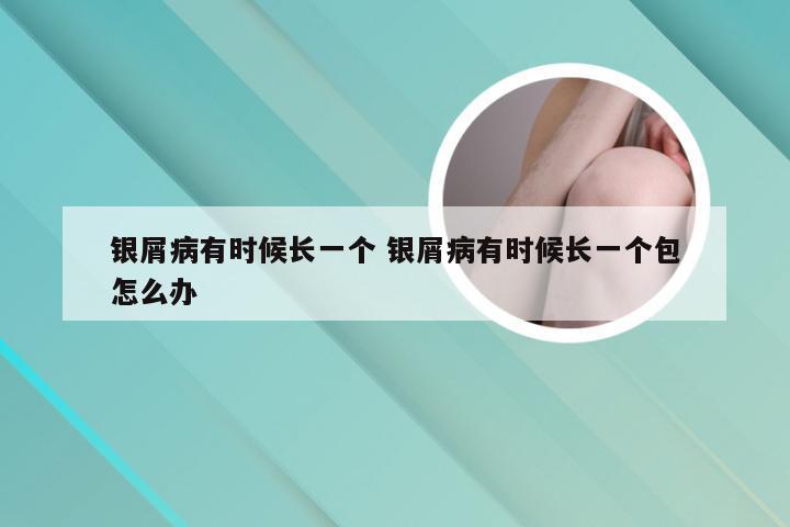 银屑病有时候长一个 银屑病有时候长一个包怎么办