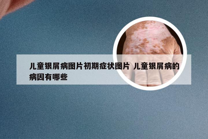 儿童银屑病图片初期症状图片 儿童银屑病的病因有哪些