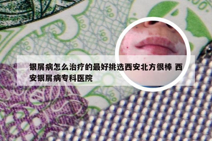 银屑病怎么治疗的最好挑选西安北方很棒 西安银屑病专科医院