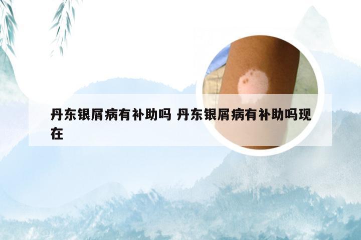 丹东银屑病有补助吗 丹东银屑病有补助吗现在