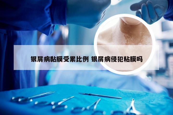 银屑病黏膜受累比例 银屑病侵犯粘膜吗