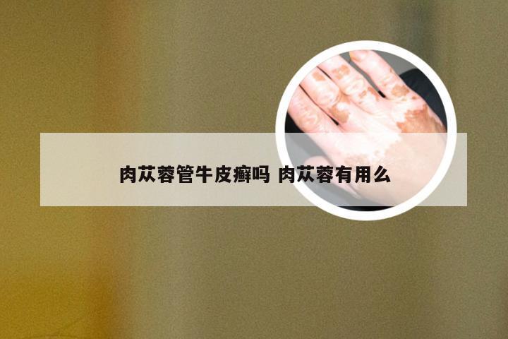 肉苁蓉管牛皮癣吗 肉苁蓉有用么